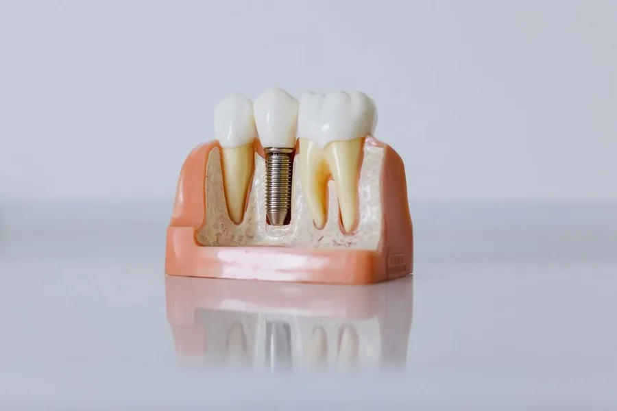 Dental implant model used to explain dental implants in Fort Myers