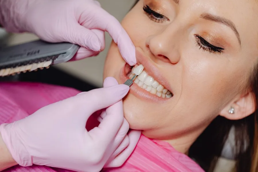 Veneer shade being matched to a patient's smile in Fort Myers